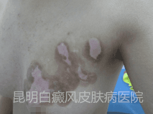 14岁女生胸部患白癜风4个月余,在我院康复