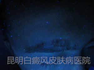 眉角白斑,在我院1个月康复