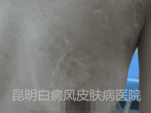 14岁女生胸部患白癜风4个月余,在我院康复