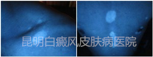 20岁男性身上多块白斑,在我院成功康复