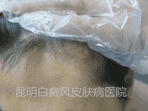男性额头白斑一年余,在我院三个月康复