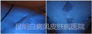 20岁男性身上多块白斑,在我院成功康复