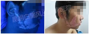 面部大面积白斑三年,在我院成功康复