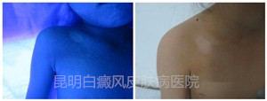 八岁女童锁骨处患白斑,在我院成功康复