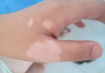 寻常型白癜风都有哪些特点