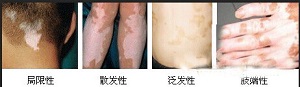 节段型白癜风患者该注意什么