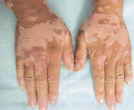 泛发型白癜风患者需要注意哪些