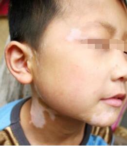 小儿患白癜风怎么护理