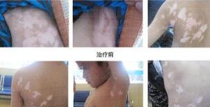 白癜风发病在腰部怎么办