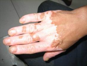 手部白癜风发病因素有哪些