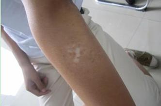 女性白癜风诱发原因是什么