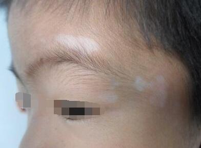 少儿患白癜风该注意哪些问题