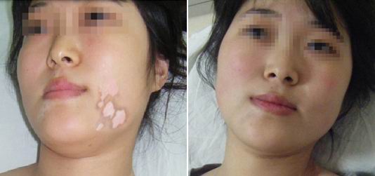 女性白癜风患者怀孕时该注意什么