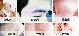 白癜风疾病如何进行诊断