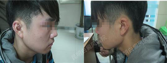 新浪网:白癜风的治疗方法推荐—中西医结合治疗