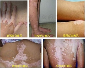 寻常型白癜风还有哪些类型