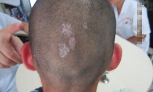 白癜风症状变化了,是好转了吗?