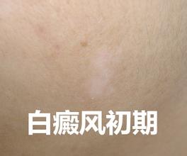 寻常型白癜风都有哪些症状呢?