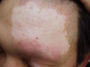 【昆明治白殿邀毛春光】面部白癜风用激光治疗怎么样?