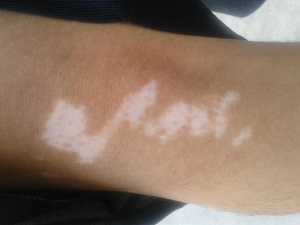 主播向王思聪讨薪?手臂上长白斑还能当主播吗?