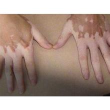 老师用铁尺扇学生?外伤会导致手臂白癜风吗?