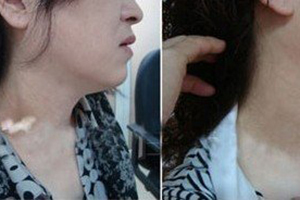 体内激素的波动会引起白癜风吗?