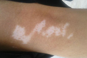 白斑不会自愈 那会有哪些症状?