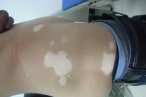 什么样才是白癜风