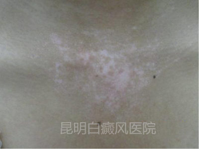 花季少女结束2年白斑摧残