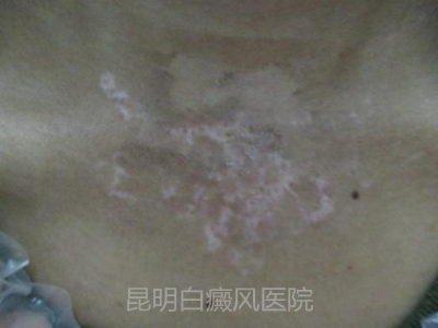 花季少女结束2年白斑摧残
