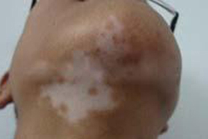 白癜风一出生就会有吗