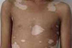 哪些因素导致身上长白斑?