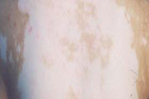 全身白斑病如何治?能治好吗