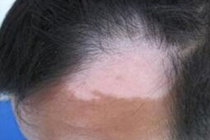 白癜风会导致睫毛头发变白吗?