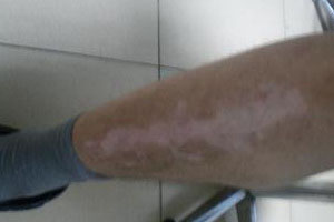 为什么大腿上会患上白癜风