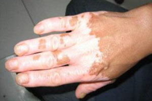 白癜风存在着哪些危害?