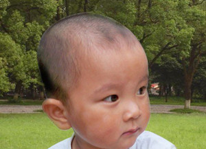 预防儿童白癜风的方法有哪些?