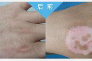 出现这些症状表现白斑在好转