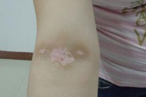 白癜风治疗是这样的,你肯定没想到