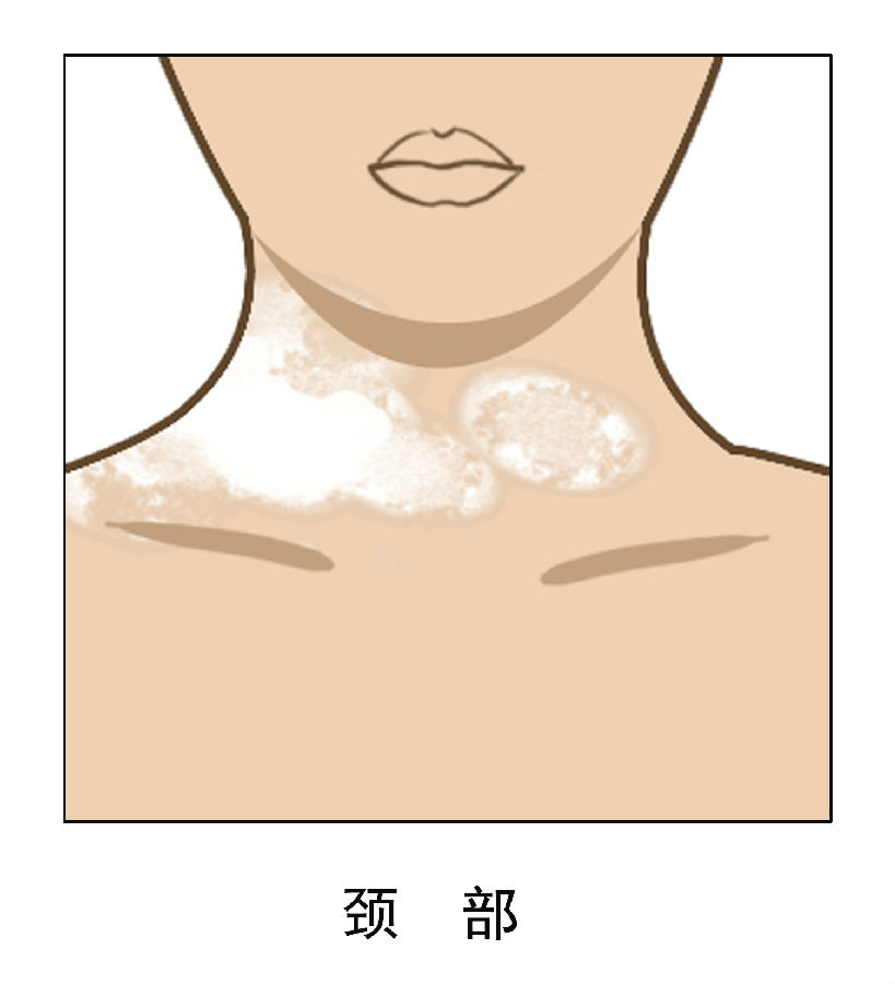 脖子白癜风的有效治疗方法